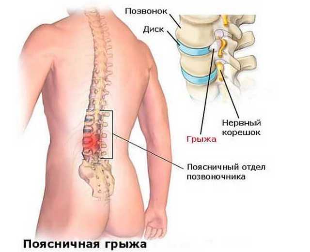 Гиперэкстензия при грыже в поясничном отделе thumbnail