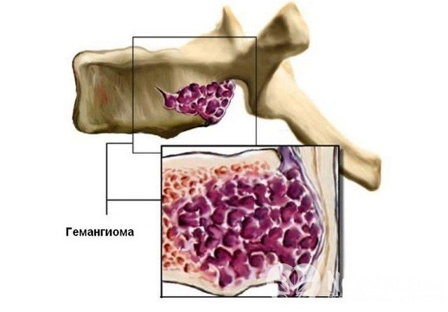 Методы лечения гемангиомы позвоночника поясничного отдела thumbnail