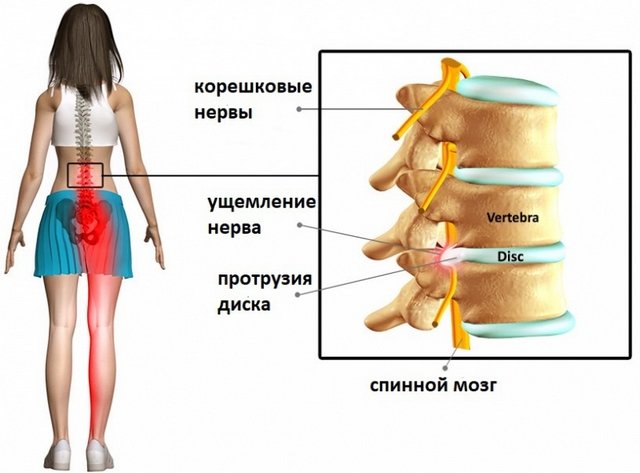 Протрузия может долгое время не проявлять себя, но, несмотря на это, развиваться