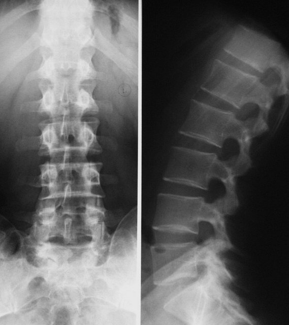 Рентгеновский снимок поможет определить, развивается ли в позвоночнике протрузия