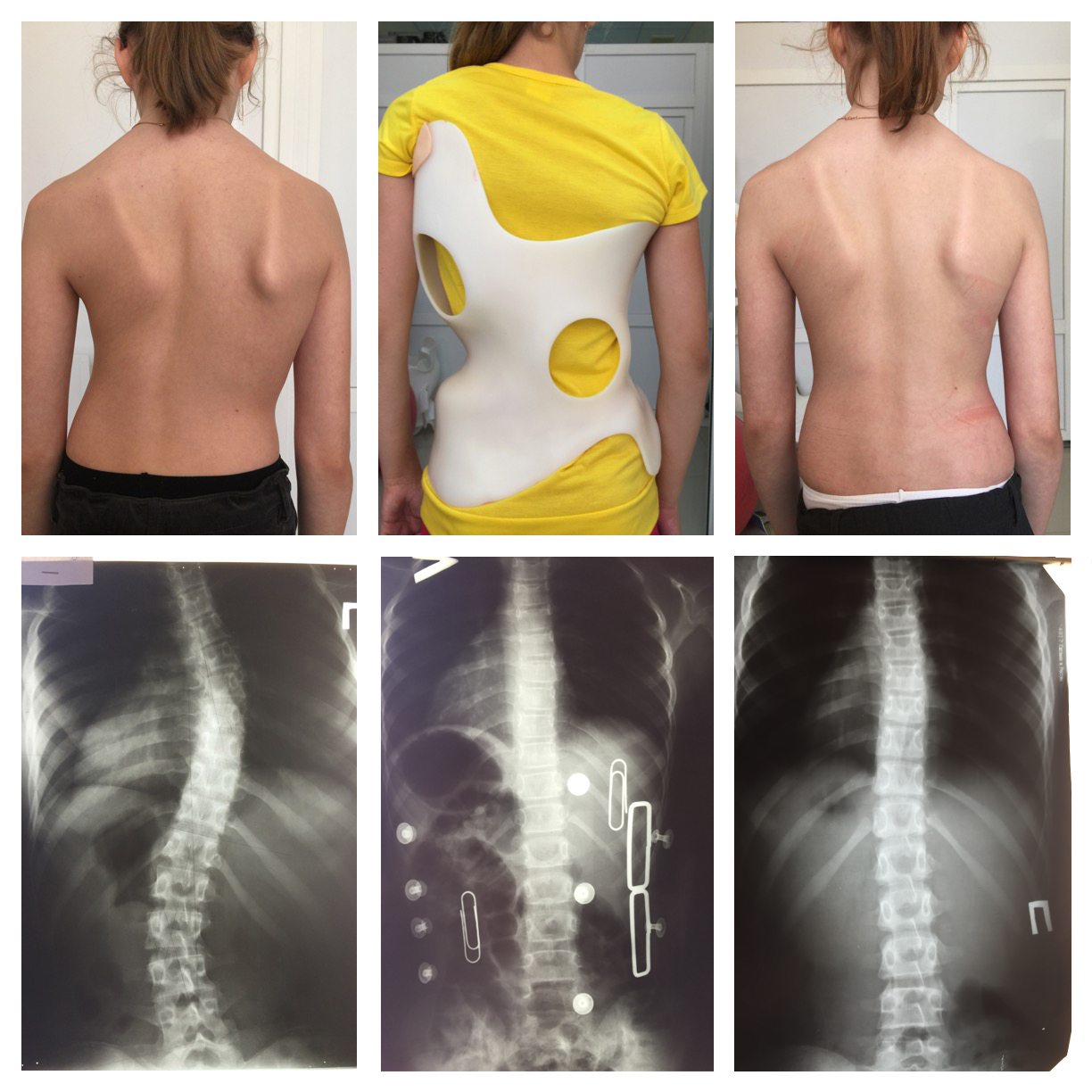 фото спины после операции