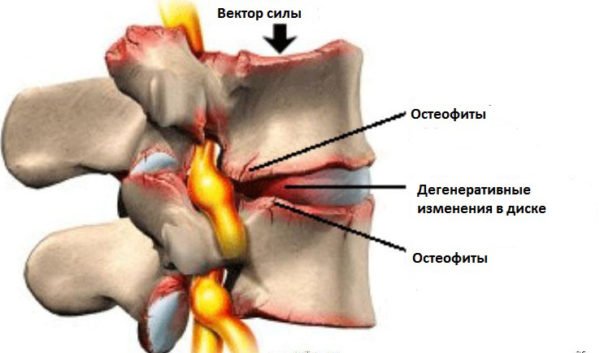 Краевые остеофиты тел позвонков