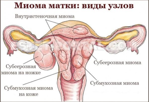 Миома матки – это доброкачественное гормонозависимое образование матки, развивающееся из мышечной ткани в виде миоматозного узла
