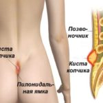 Болит спина в районе копчика у женщин