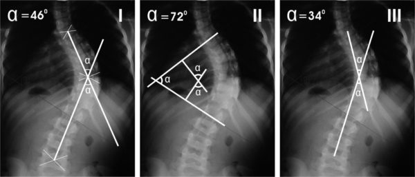 Рентгеновские снимки позвоночника со сколиозом