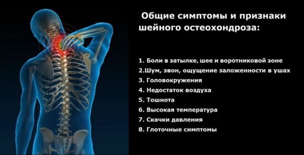 Симптомы и признаки шейного остеохондроза