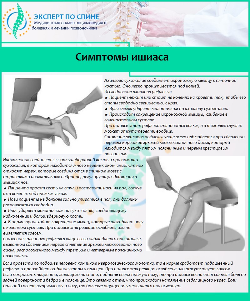 Защемило поясницу что делать. Люмбоишиалгия поясничного отдела позвоночника. Ишиас симптомы. Люмбоишиалгия симптомы. Седалищный нерв симптомы.