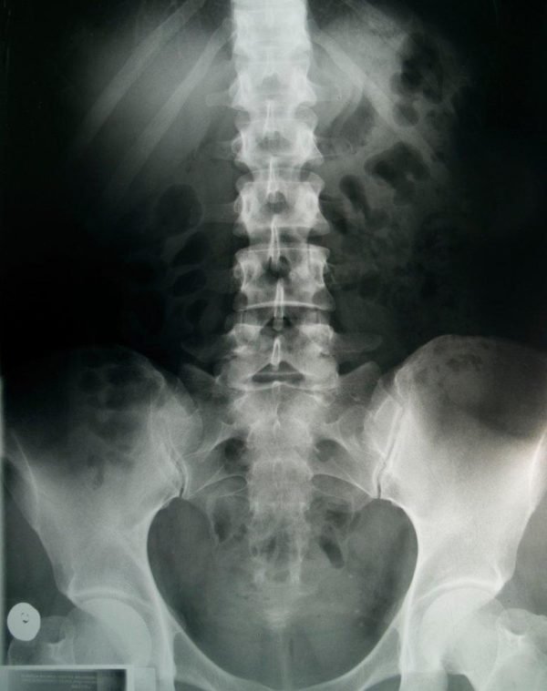 Выявление ишиаса с помощью рентгена