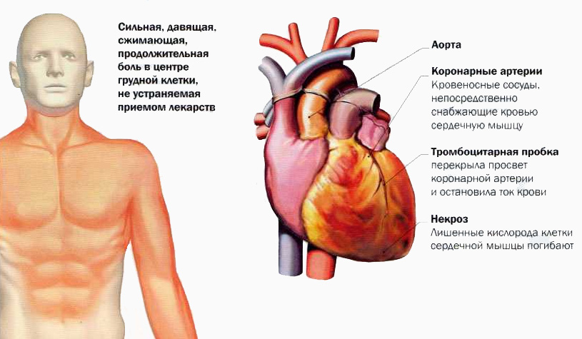 Сильная давящая боль. Сердечная мышца болит симптомы. Болит мышца в области сердца. Боль сердечной мышцы симптомы.