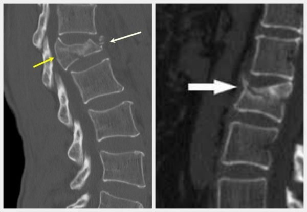 Лфк мышц спины при компрессионном переломе позвоночника thumbnail