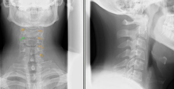 На рентгеновском снимке - остеохондроз шейного отдела