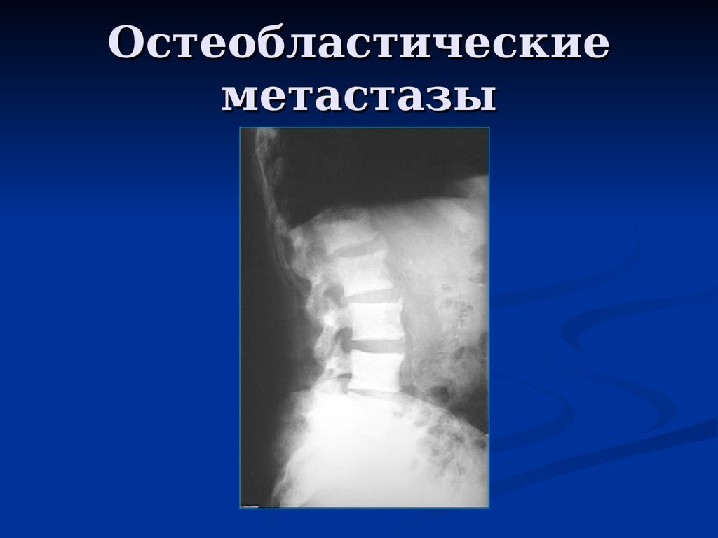 Метастатическое поражение костей. Остеобластические метастазы позвоночника рентген. Остеобластические очаги метастаз рентген. Остеосаркома остеобластическая форма. Метастазы поражения позвонков.