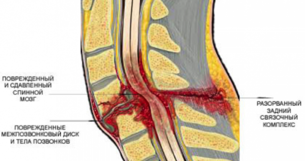Повреждение спинного мозга при травме позвоночника