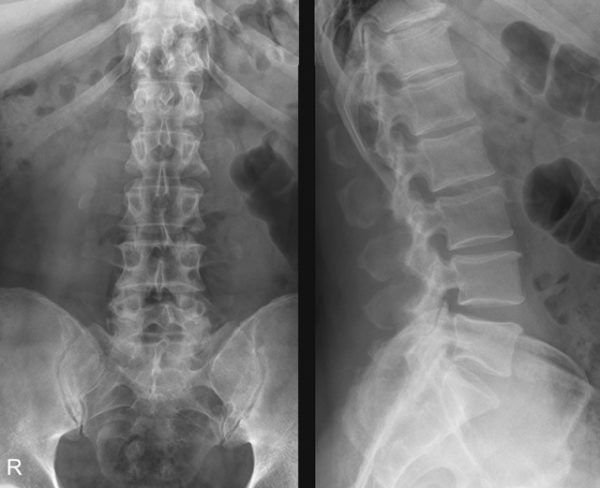 Рентген как метод обследования устарел и уступает УЗ-диагностике