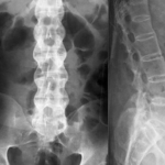 Рентгенография грудного и поясничного крестцового отделов thumbnail