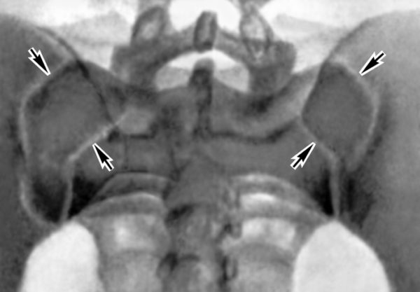 Рентгенограмма крестцово-подвздошных суставов в норме (прямая задняя проекция)