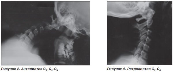 Унковертебральный артроз шейного отдела позвоночника