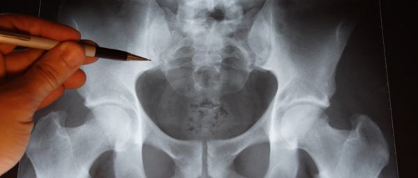 В современной науке перелом крестцового отдела позвоночника определяется в качестве достаточно редкой травмы, связанной с избыточным давлением на область костей