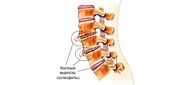Остеофиты - костные наросты в виде шипов или крючков, расположенные по краям позвонков