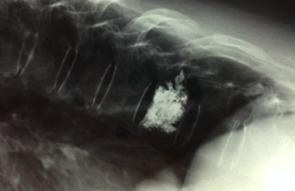 Боковой рентген после вертебропластики