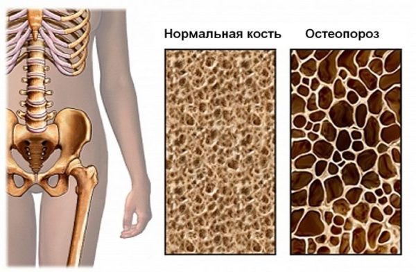 Пораженная остеопорозом кость