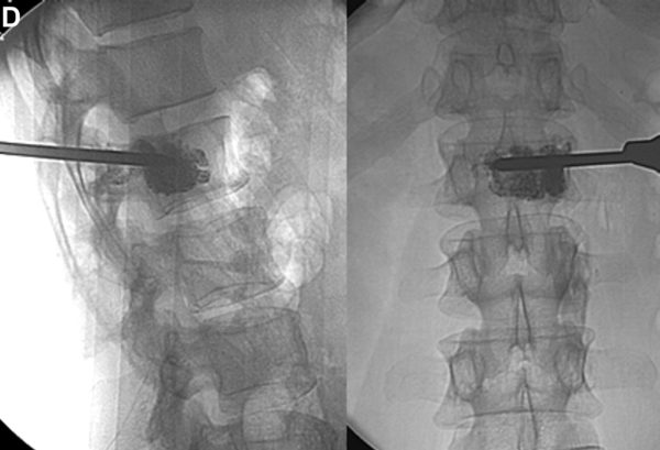 Рентгенографическая картина во время вертебропластики тел позвонков