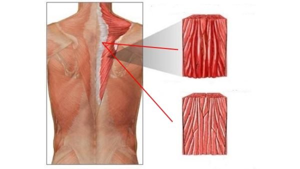 Схема миозита спинных мышц