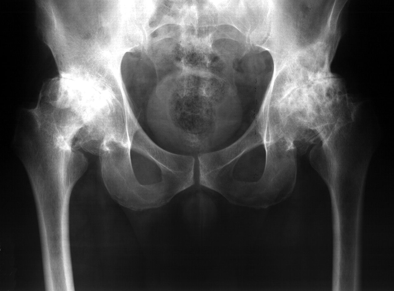 Медицина суставы тазобедренный. Диспластический коксартроз рентген. Коксартроз тазобедренного сустава рентген. Деформирующий артроз тазобедренного сустава рентген. Остеоартроз тазобедренного сустава рентген.