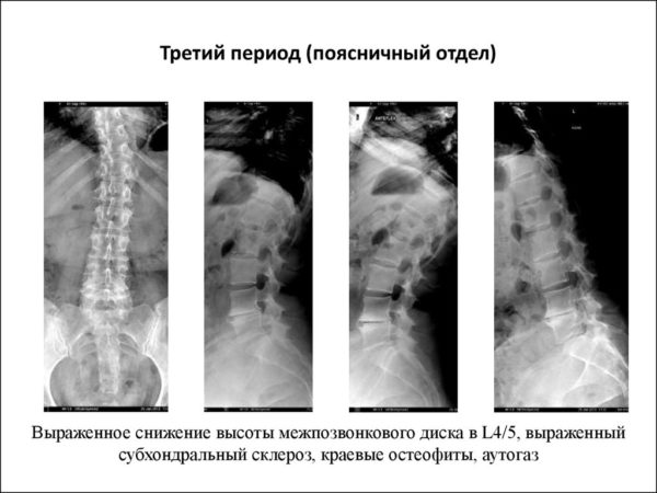 Субхондральный склероз на рентгене