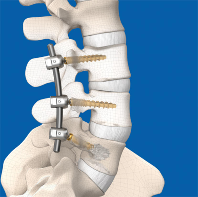 Тпф позвоночника. Транспедикулярный остеосинтез. Транспедикулярная фиксация l5-s1. Транспедикулярная фиксация th11-l2. Stryker Xia 3 система транспедикулярной фиксации.