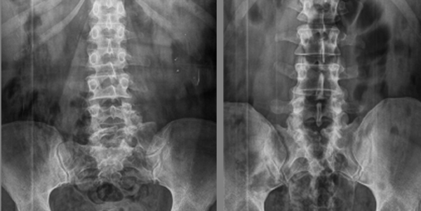 С помощью рентгенографии можно выявить сращивание позвонка с крестцом и другие патологии 