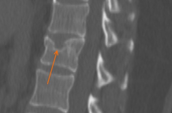 Выявить грыжу Шморля на ранней стадии можно лишь при помощи рентгенографии или МРТ