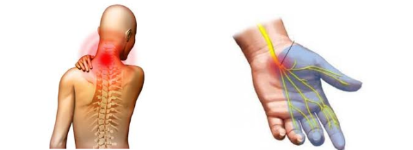 Защемление в области шее обычно проявляется болью в затылке, распространяющейся на плечевой пояс и руки, а также нарушением чувствительности в верхних конечностях