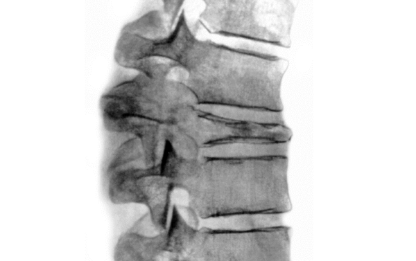 С помощью рентгеновского снимка врач может оценить состояние позвонков, толщину межпозвонковых дисков, плотность костной ткани