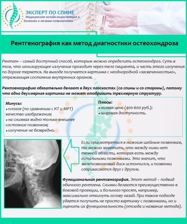 Рентгенография как метод диагностики остеохондроза