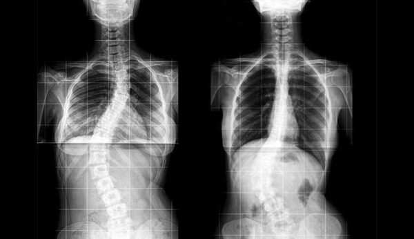 Диагностика идиопатического сколиоза осуществляется с помощью рентгенографии