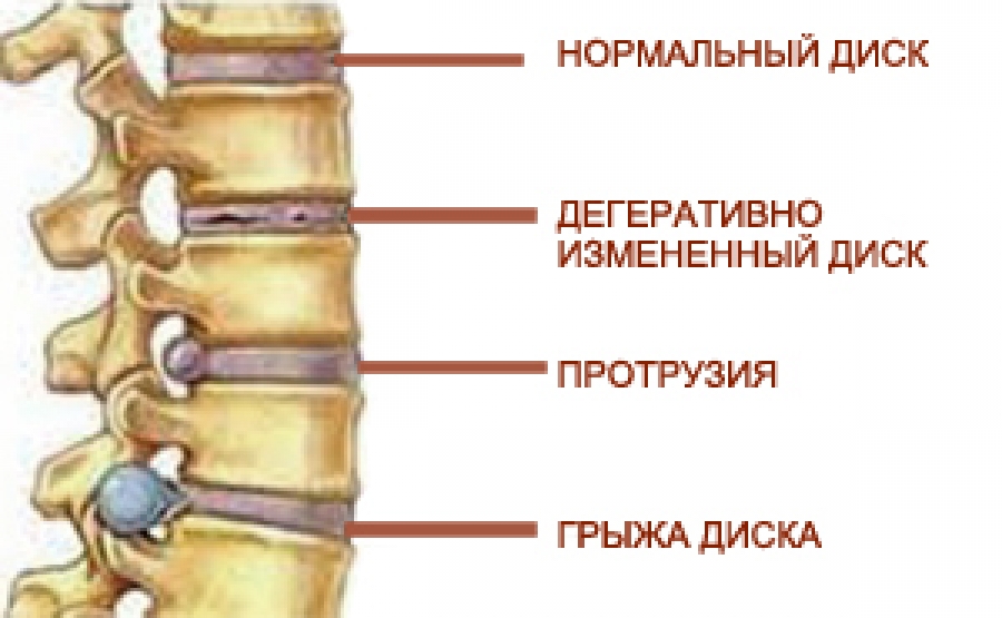 Фото протрузии дисков позвоночника