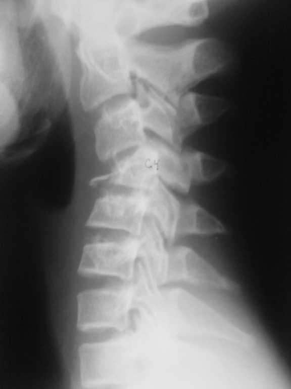 Перелом поясницы. Перелом 12 грудного позвонка рентген. Перелом шейных позвонков рентген компрессионный. Что такое компрессионный перелом 5 шейного позвоночника. Компрессионный перелом шейного отдела позвоночника рентген.