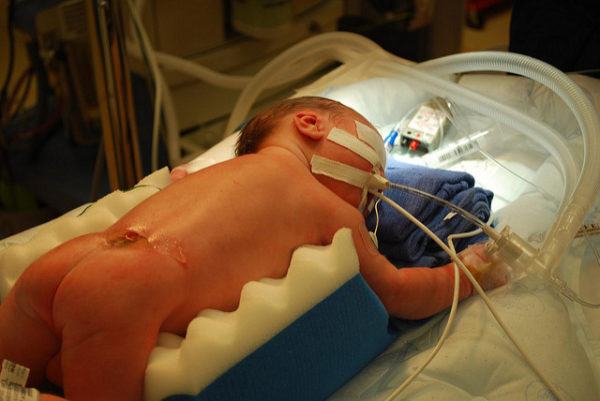 Расщепление позвоночника у новорожденных фото thumbnail