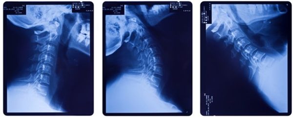 Рентгеновский снимок шейного отдела
