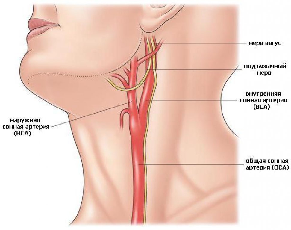 Нерв пищевода. Атеросклеротическая бляшка в сонной артерии. Сонная артерия анатомия человека. Атеросклероз сосудов сонных артерий. Атеросклероз артерия брахиоцефальных артерий.