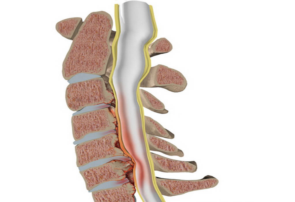Стеноз позвоночного канала что это такое и как лечить симптомы фото