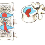 Грыжа грудного отдела позвоночника шморля