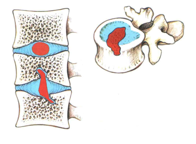 Узлы Шморля в позвоночнике - симптомы, лечение, профилактика