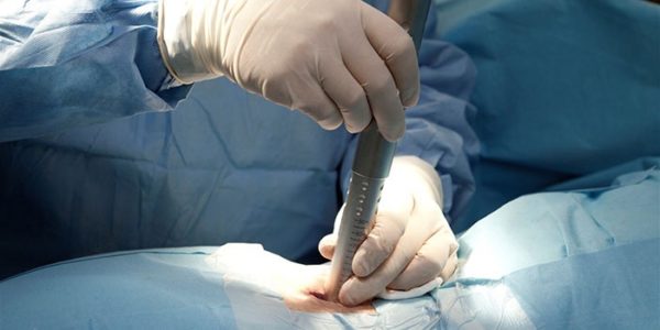 При невозможности провести операцию с помощью эндоскопа прибегают к микрохирургической методике