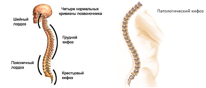 Лордоз и кифоз позвоночника фото