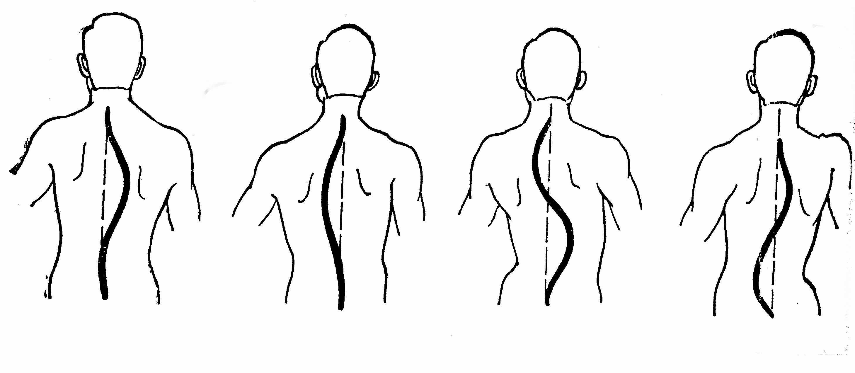 Сколиоз рисунок позвоночника