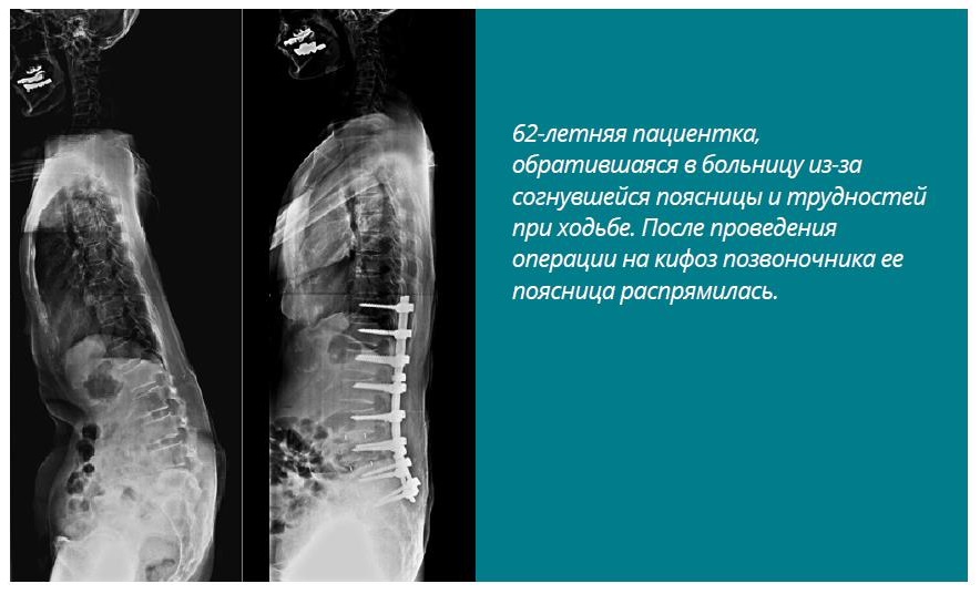 Кифотическая установка шейного отдела