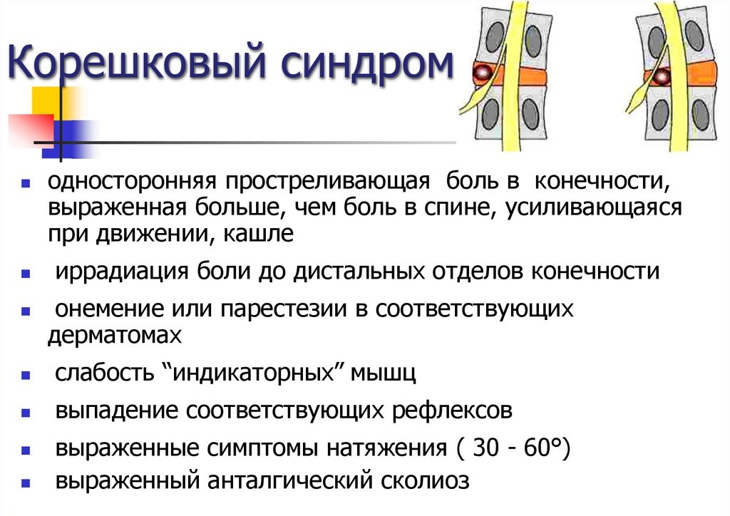 Карта вызова остеохондроз поясничного отдела позвоночника корешковый синдром