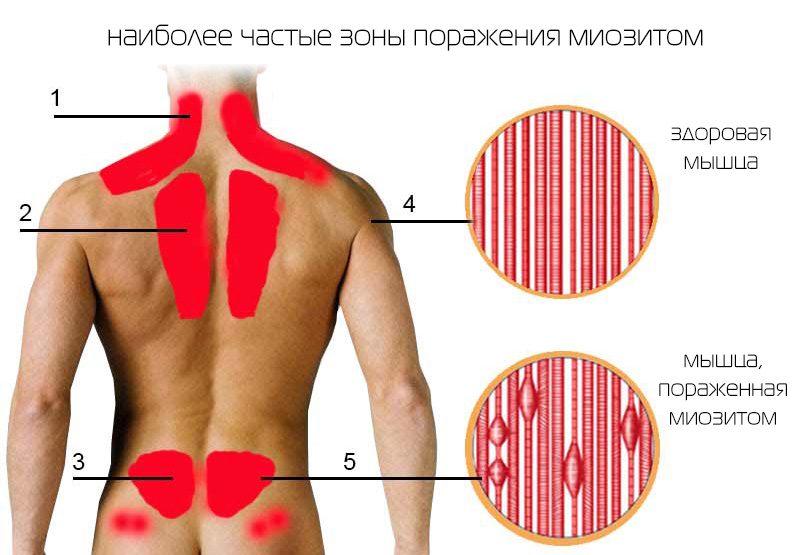 Миозит с включениями клиническая картина